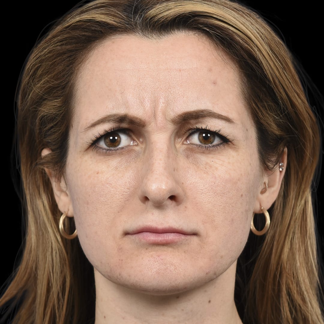 Botox Before, Female 28 - 4890