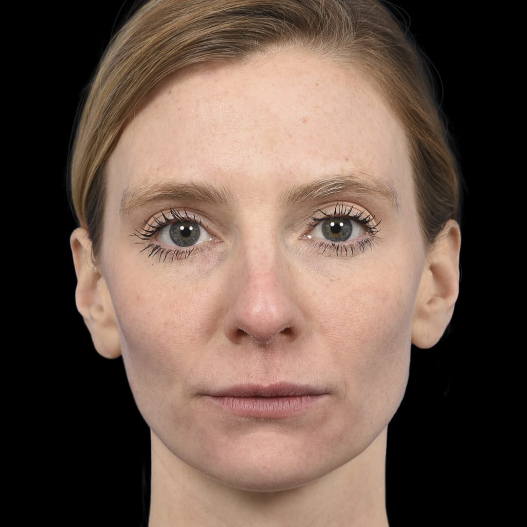 Botox After, Female 29 - 4892