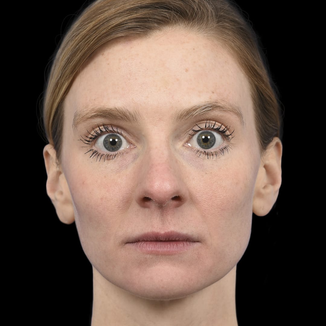 Botox After, Female 29 - 4893