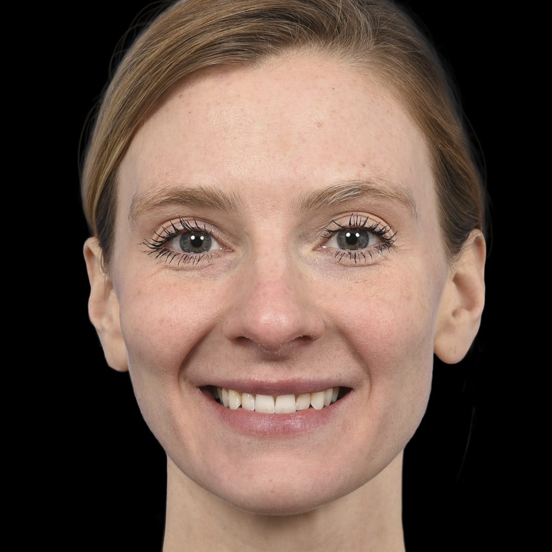 Botox After, Female 29 - 4891