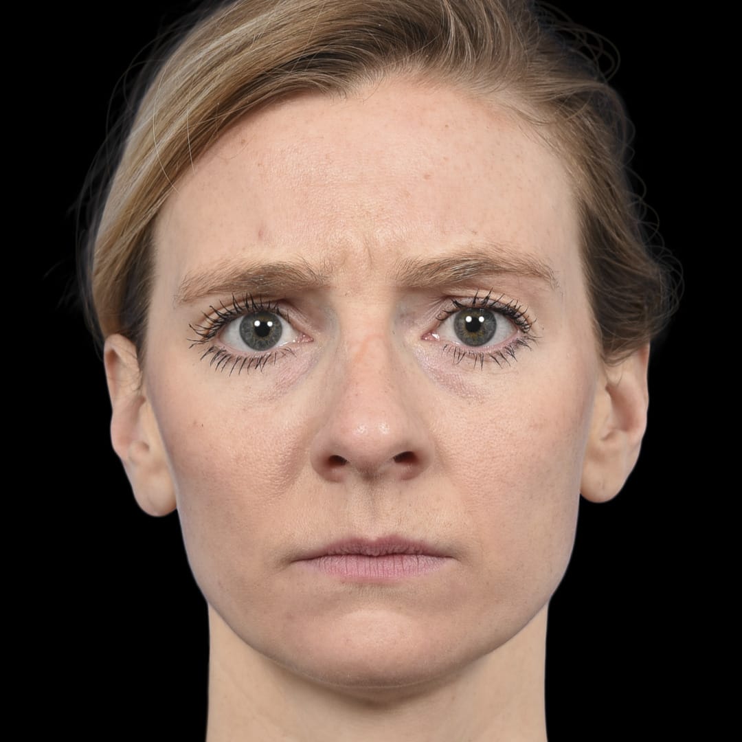 Botox Before, Female 29 - 4892