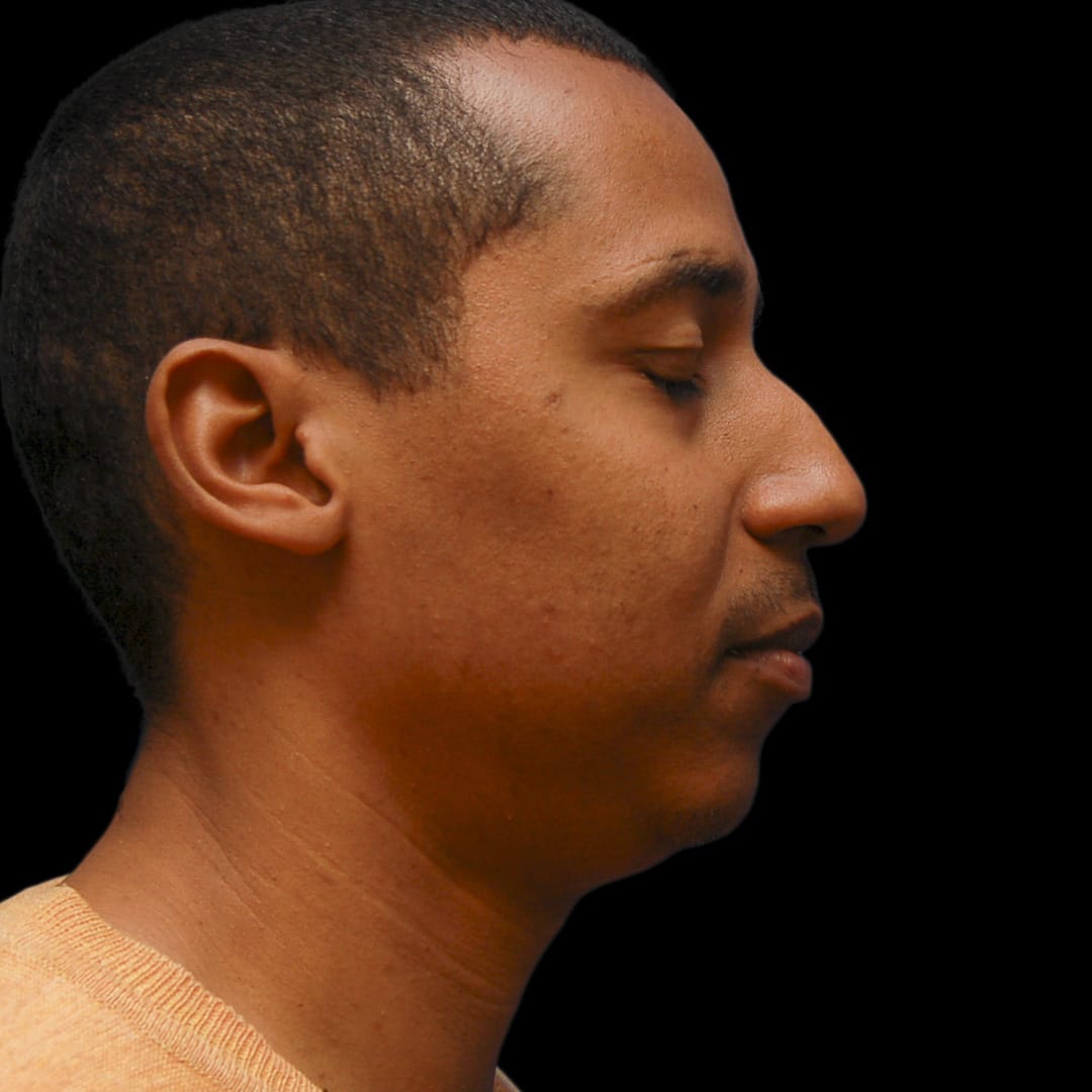Chin Augmentation Before, Male 44 - 4897