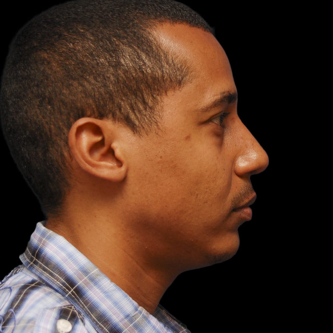 Chin Augmentation After, Male 44 - 4897