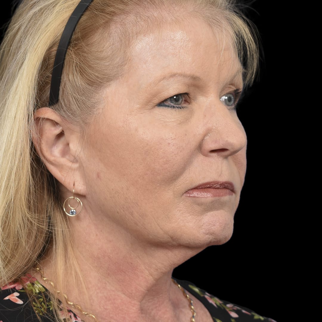 Deep Plane Facelift Before, Female 56 - 4934