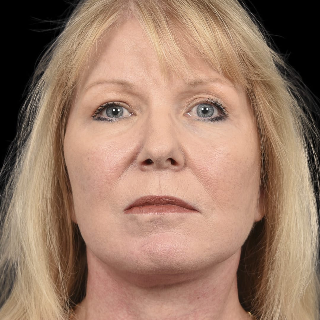 Deep Plane Facelift After, Female 58 - 4933