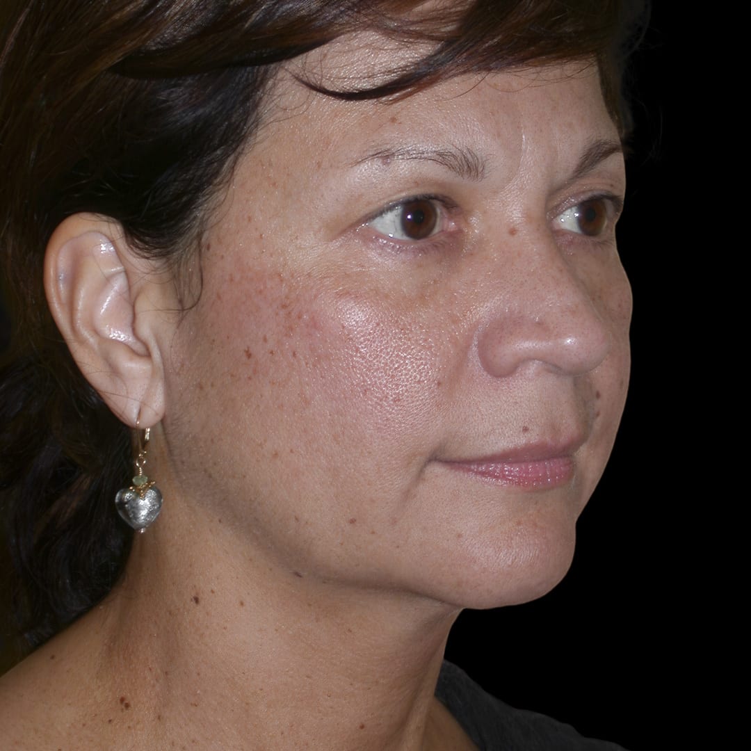 Facelift Before, Female 53 - 4937