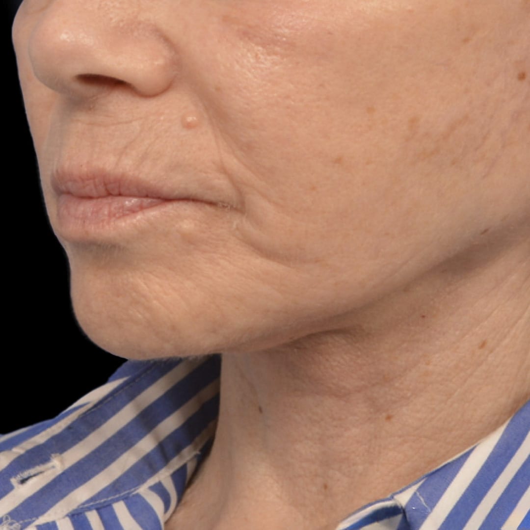 Facelift After, Female 63 - 4941