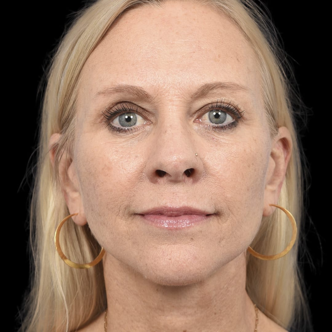 Neck Lift After, Female 53 - 4894