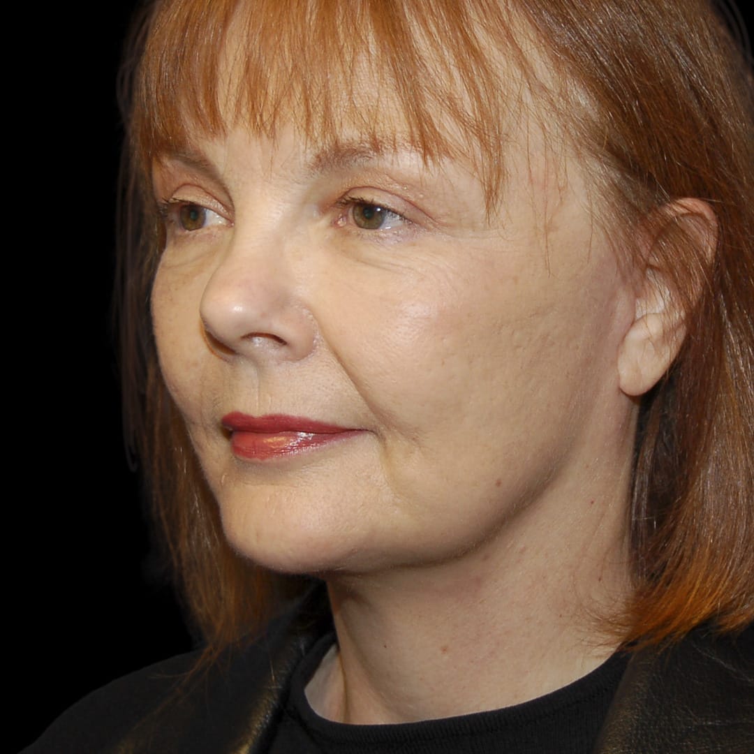 Neck Lift After, Female 56 - 4899