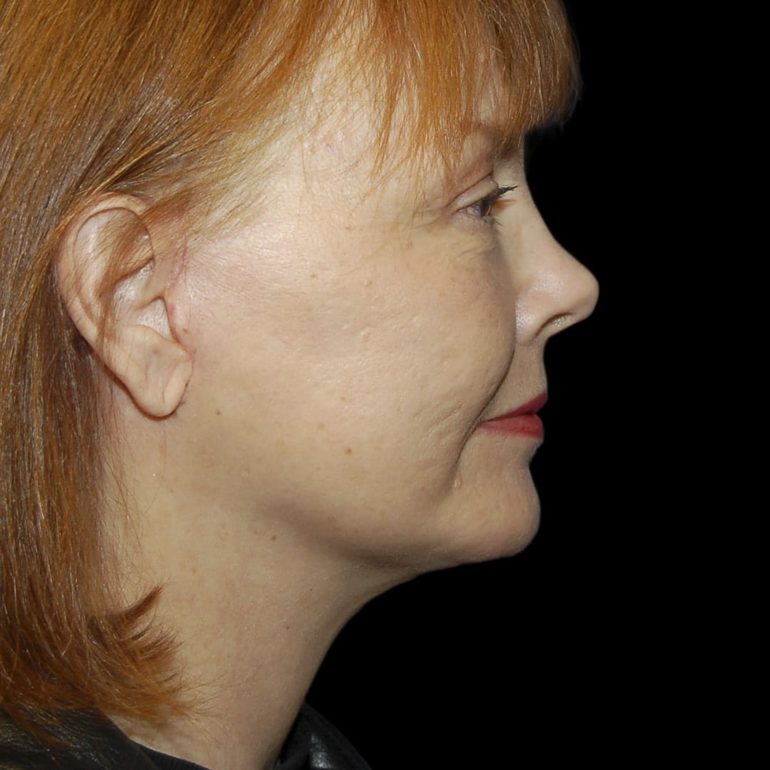 Neck Lift After, Female 56 - 4900
