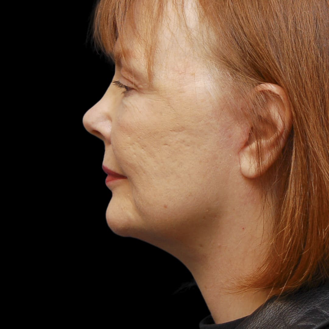 Neck Lift After, Female 56 - 4901