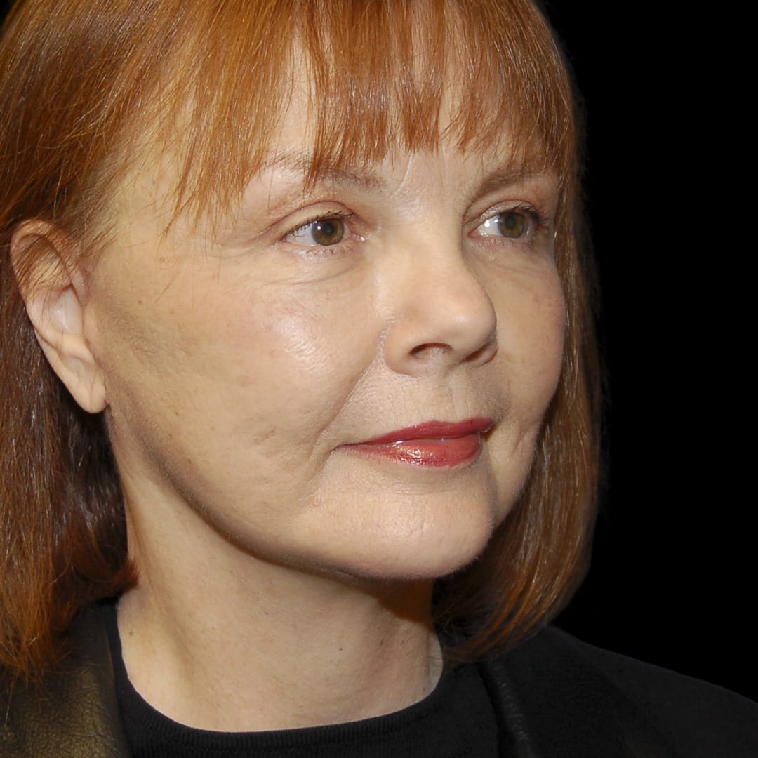 Neck Lift After, Female 56 - 4898