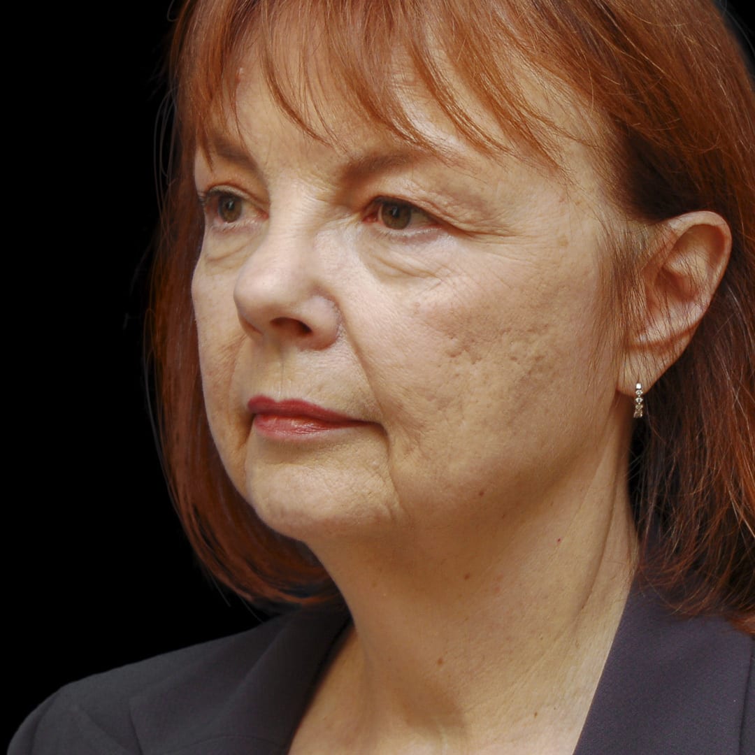 Neck Lift Before, Female 56 - 4899