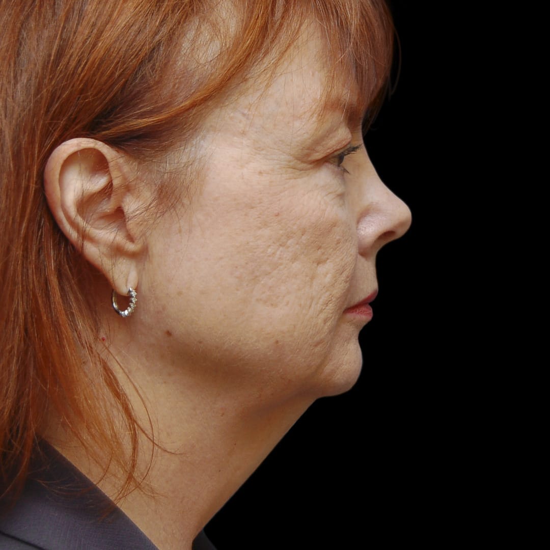 Neck Lift Before, Female 56 - 4900