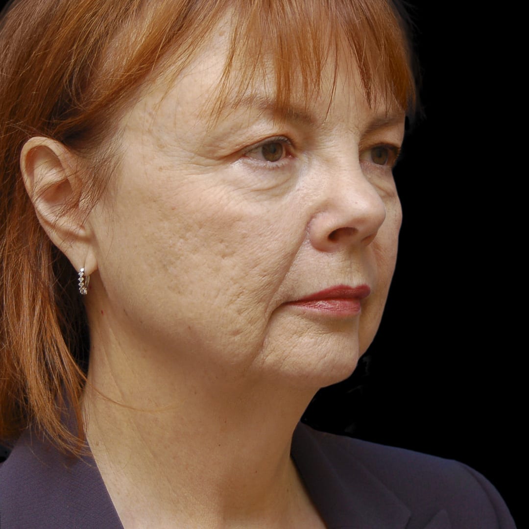 Neck Lift Before, Female 56 - 4898