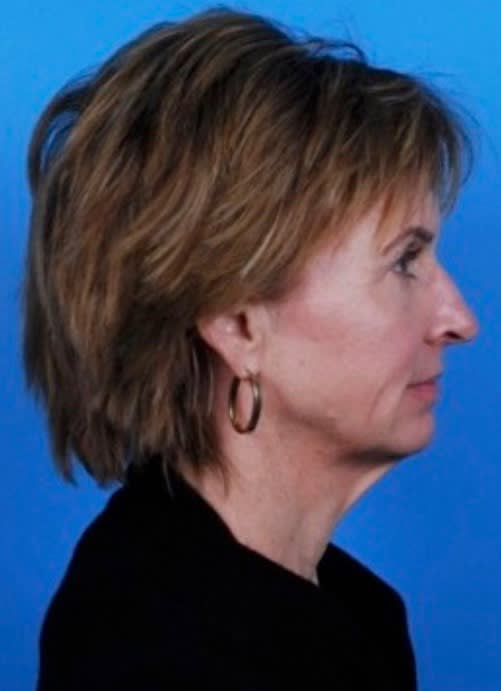 Facelift Before, Female 54 - 2332