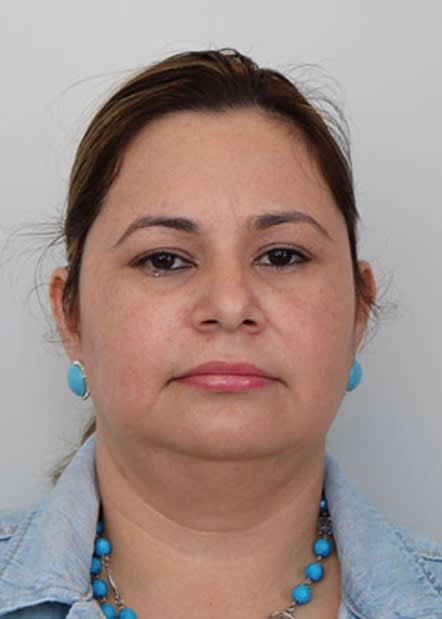 Submental Liposuction Before, Female 51 - 2348