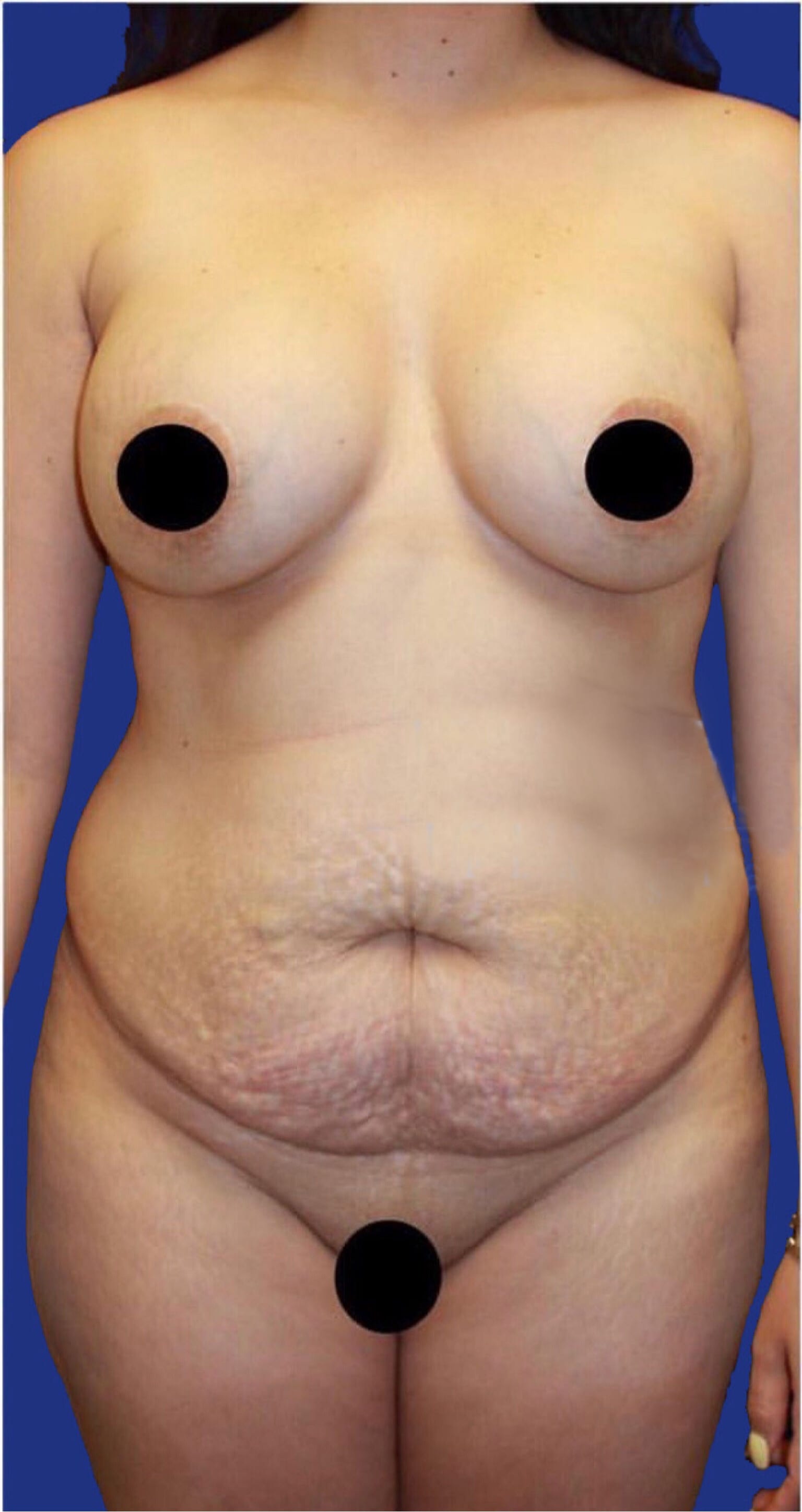 Tummy Tuck (Abdominoplasty) Before, Female 35 - 116
