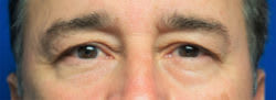 Blepharoplasty Before, Male 55 - 2624