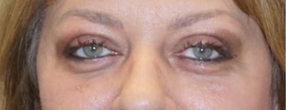 Blepharoplasty After, Female 57 - 2626