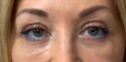 Blepharoplasty After, Female 44 - 2625