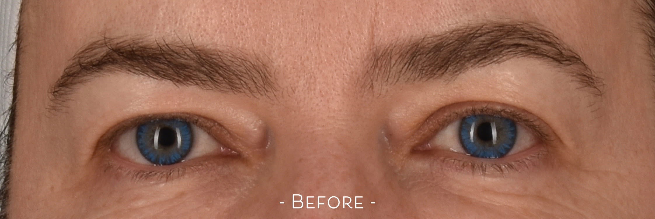 Blepharoplasty Before, Female 54 - 3162