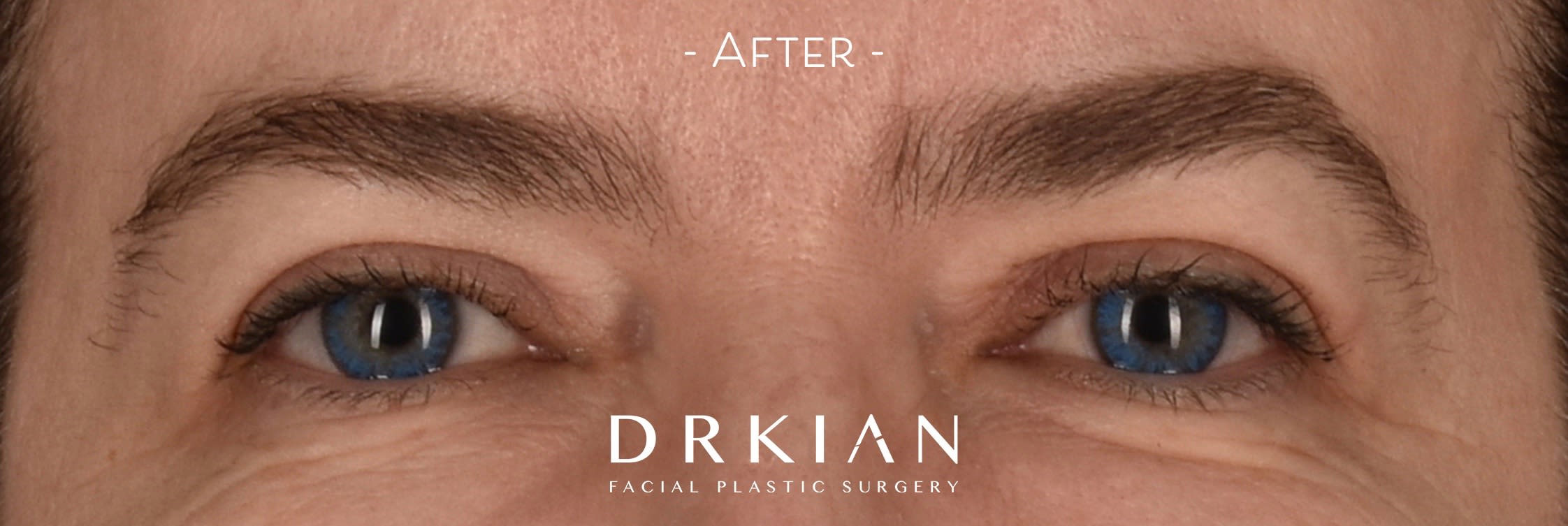 Blepharoplasty After, Female 54 - 3162