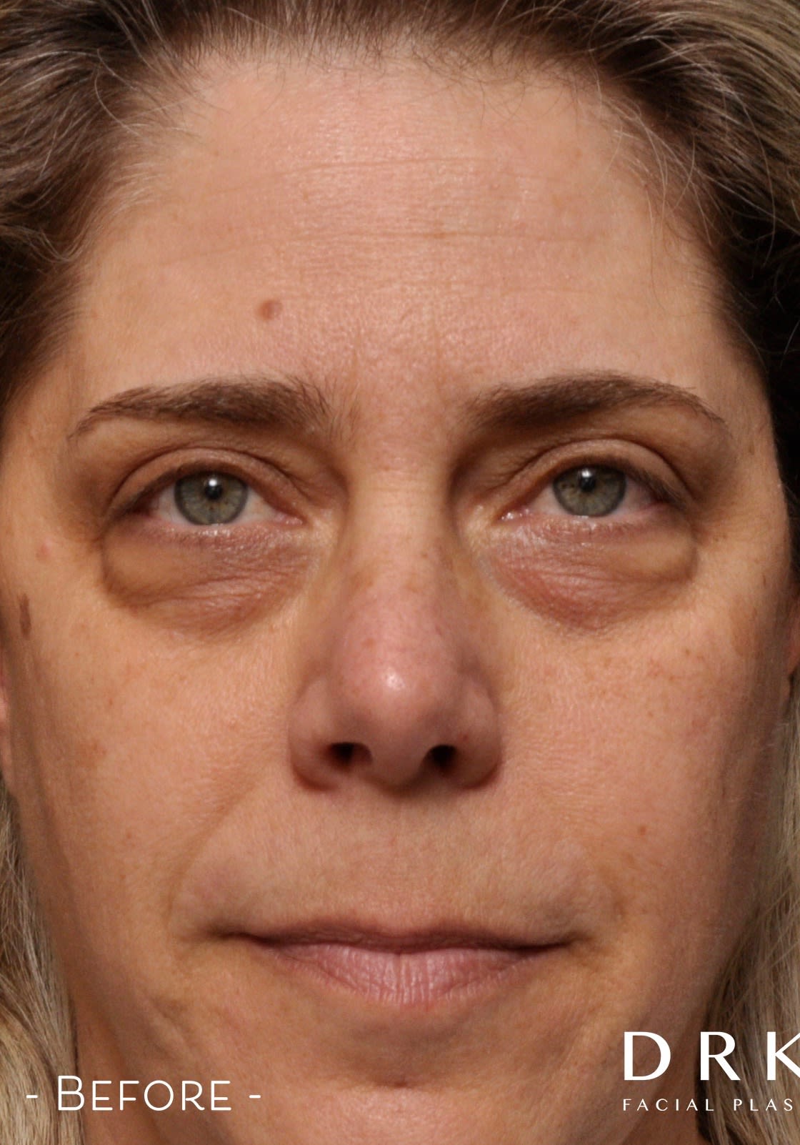 Blepharoplasty Before, Female 54 - 3163