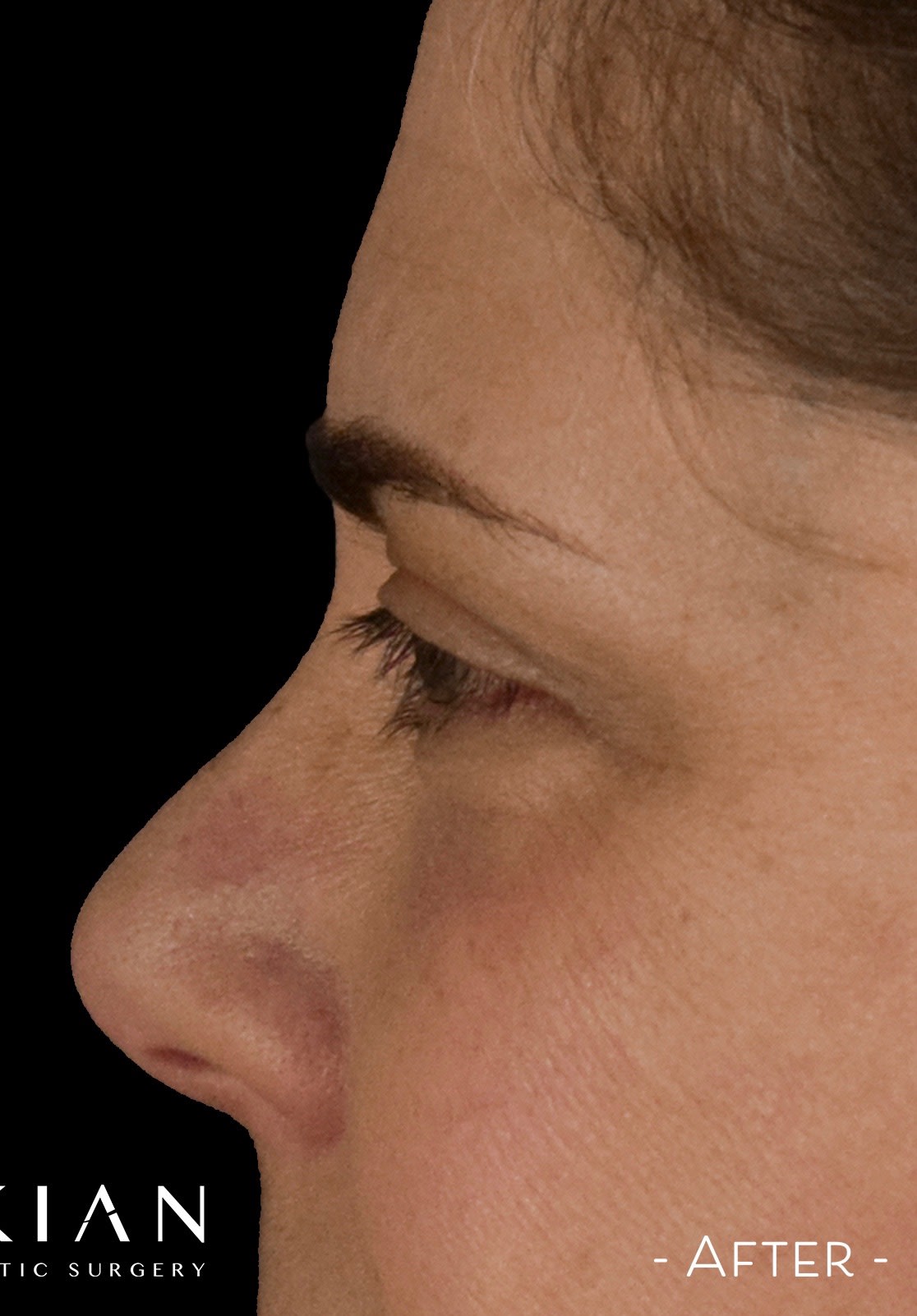 Blepharoplasty After, Female 54 - 3165