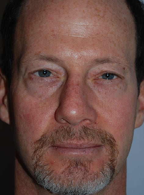 Blepharoplasty Before, Male 57 - 14