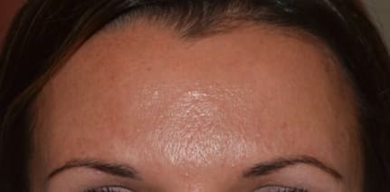 Botox After, Female 24 - 684