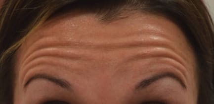 Botox Before, Female 24 - 684