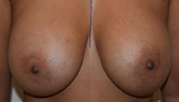 Breast Implant Removal Before, Female 43 - 261
