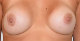 Breast Implant Removal Before, Female 33 - 262