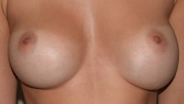 Breast Implant Removal Before, Female 24 - 263
