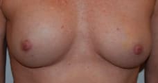 Breast Implant Removal Before, Female 57 - 264