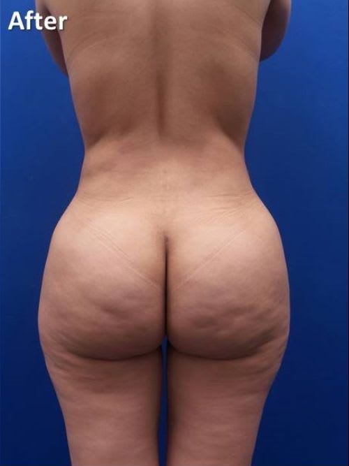 Brazilian Butt Lift After, Female 28 - 1984