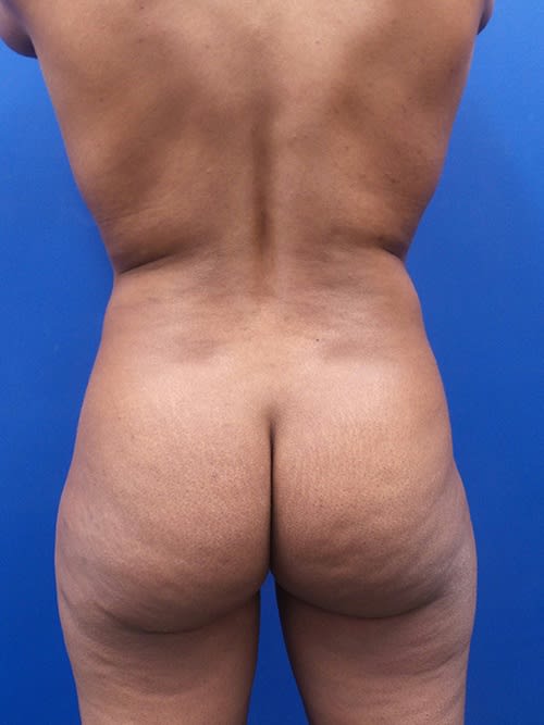 Laser-Assisted Liposuction Before, Female 39 - 1985