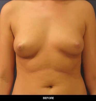 Breast Augmentation (Augmentation Mammaplasty) Before, Female 36 - 2451
