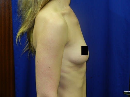 Breast Augmentation (Augmentation Mammaplasty) Before, Female 31 - 2825