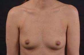 Breast Augmentation with Implants Before, Female 26 - 1943