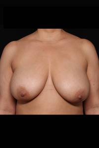 Breast Reduction Before, Female 45 - 2366