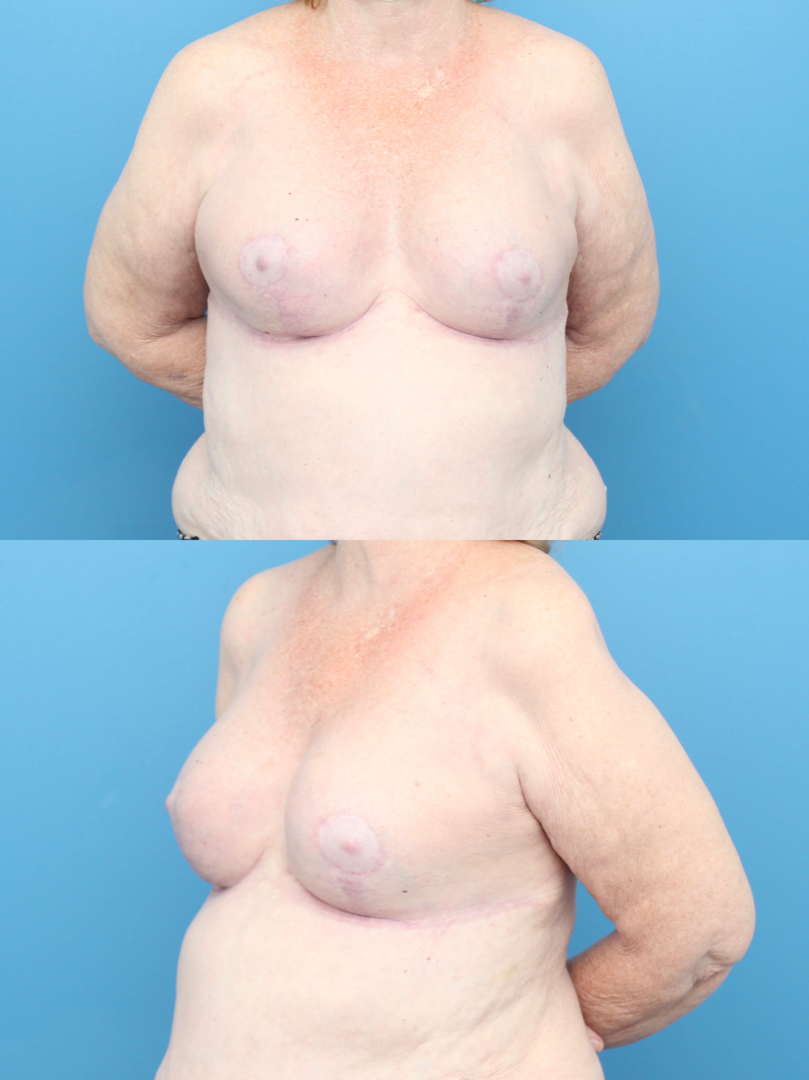 Breast Augmentation (Augmentation Mammaplasty) After, Female 65 - 1393