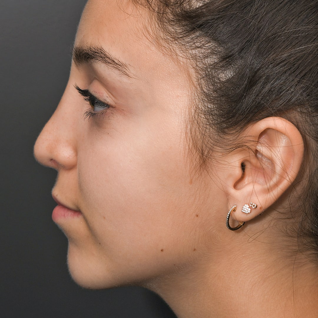 Chin Augmentation After, Female 15 - 37