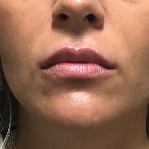 Lip Augmentation and Injections Before, Female 32 - 3732