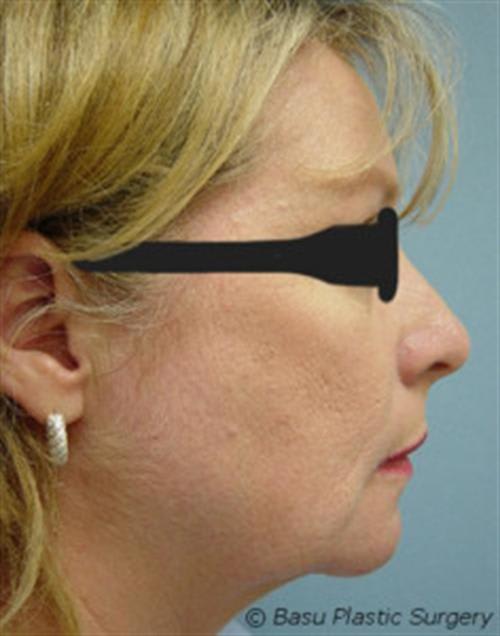 Chin Augmentation After, Female 53 - 1318
