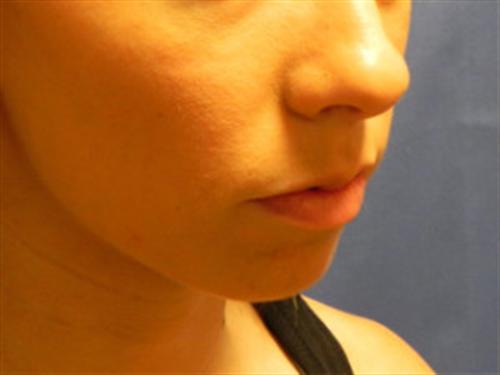 Chin Augmentation Before, Female 25 - 1319