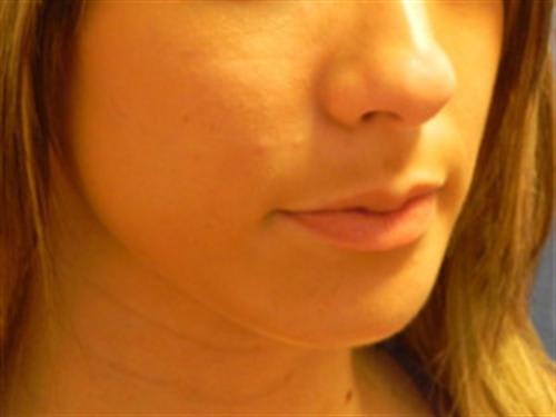 Chin Augmentation After, Female 25 - 1319