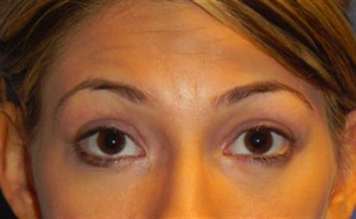 Blepharoplasty After, Female 32 - 1300