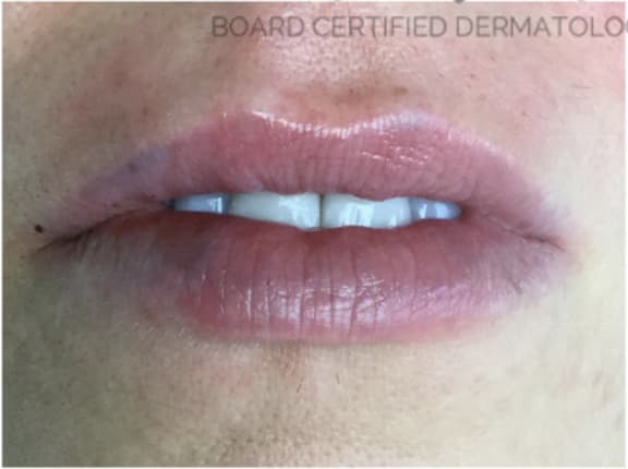 Dermal Fillers & Injectables After, Female 35 - 4359